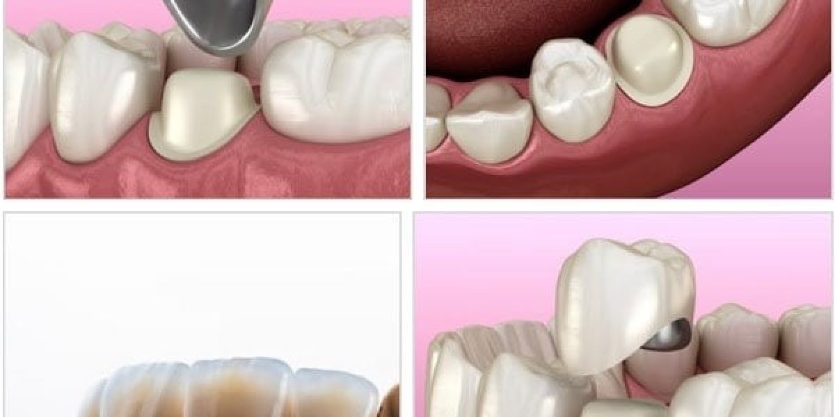 Làm Răng Sứ Có Đau Không, Làm Sao Hạn Chế Đau Khi Bọc Sứ? 