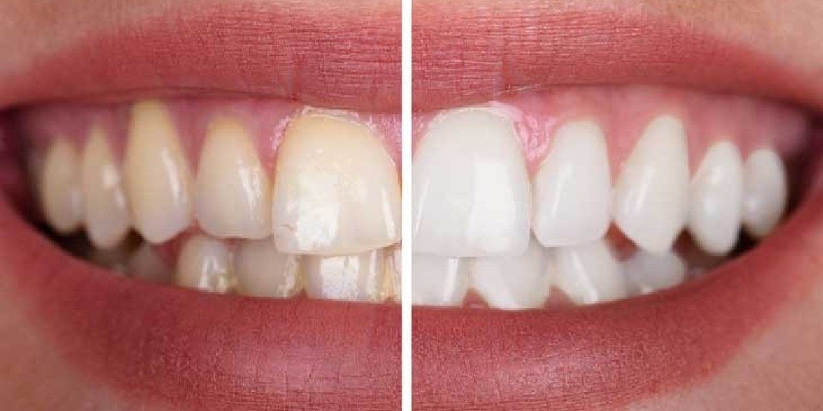 The Style Upgrade Behind Teeth Whitening Cost in Dubai
