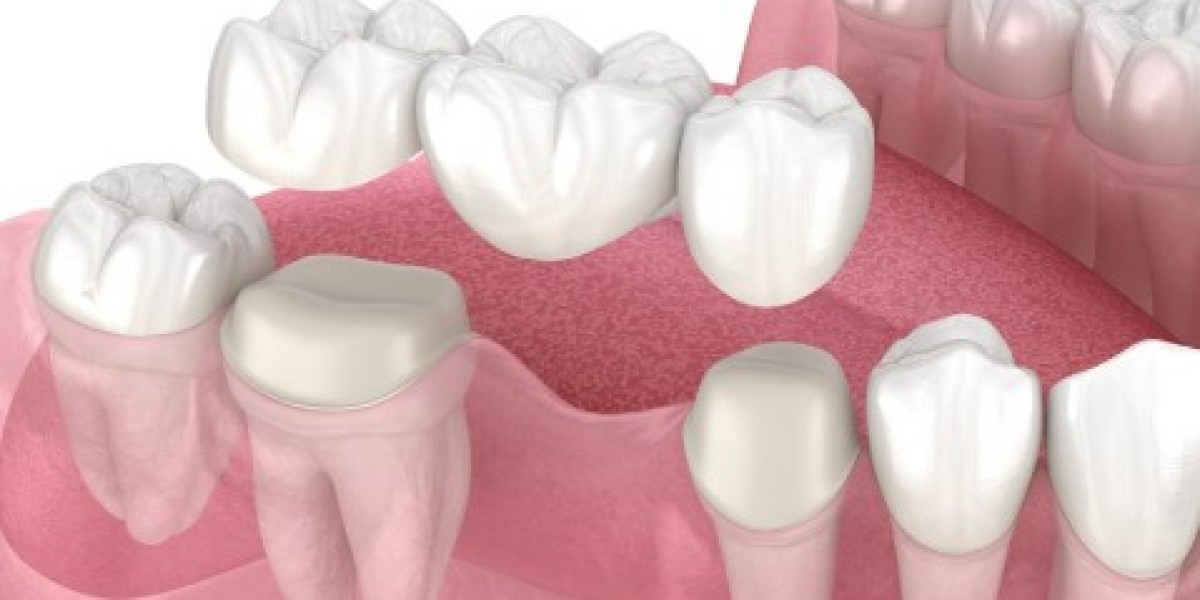 Tiêu xương hàm có trồng răng implant được không? Giải đáp chi tiết