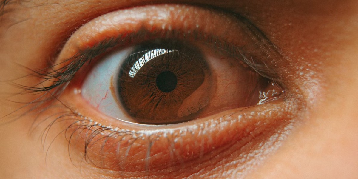 Blue Fin Vision® LASIK London: Safe, Effective, and Cost-Competitive Laser Eye Surgery