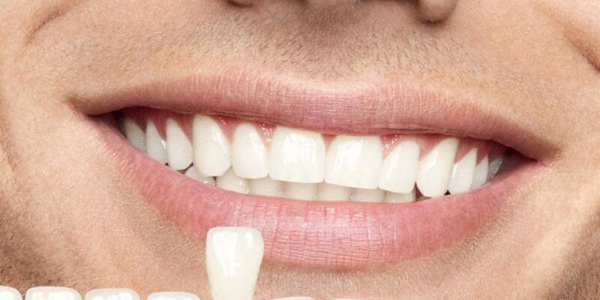 Get the Smile You’ve Always Wanted with Dental Lumineers at Serena Medical Center