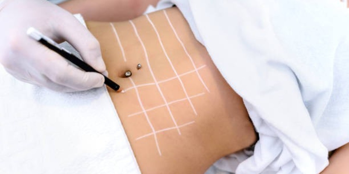 Is Liposuction in Riyadh Suitable for Men and Women?