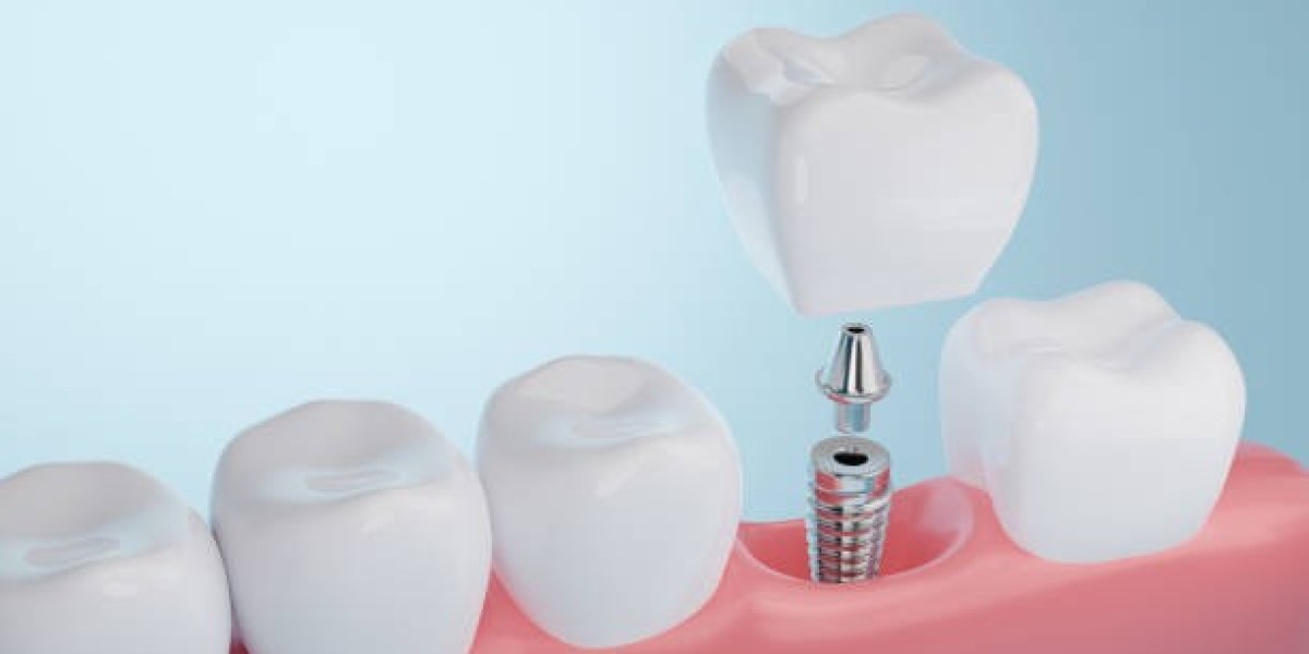 Can Dental Implants Fail? Causes and Prevention Tips