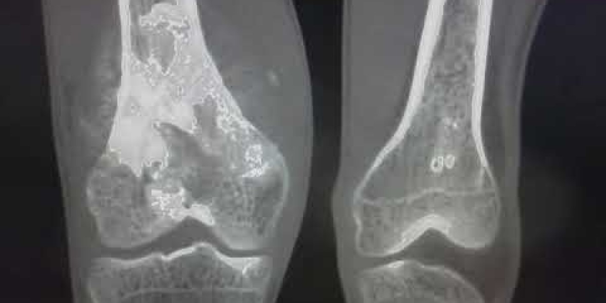 Osteosarcoma Treatment Market: Size, Trends, and Growth Analysis 2025-2032