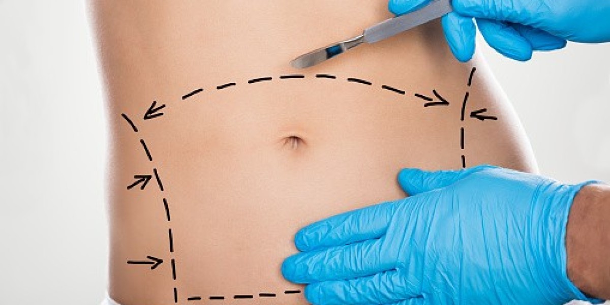 Mini Abdominoplasty in Dubai: What You Need to Know