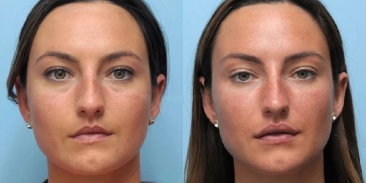 Find the Best Doctors in Dubai for Thread Lift Today