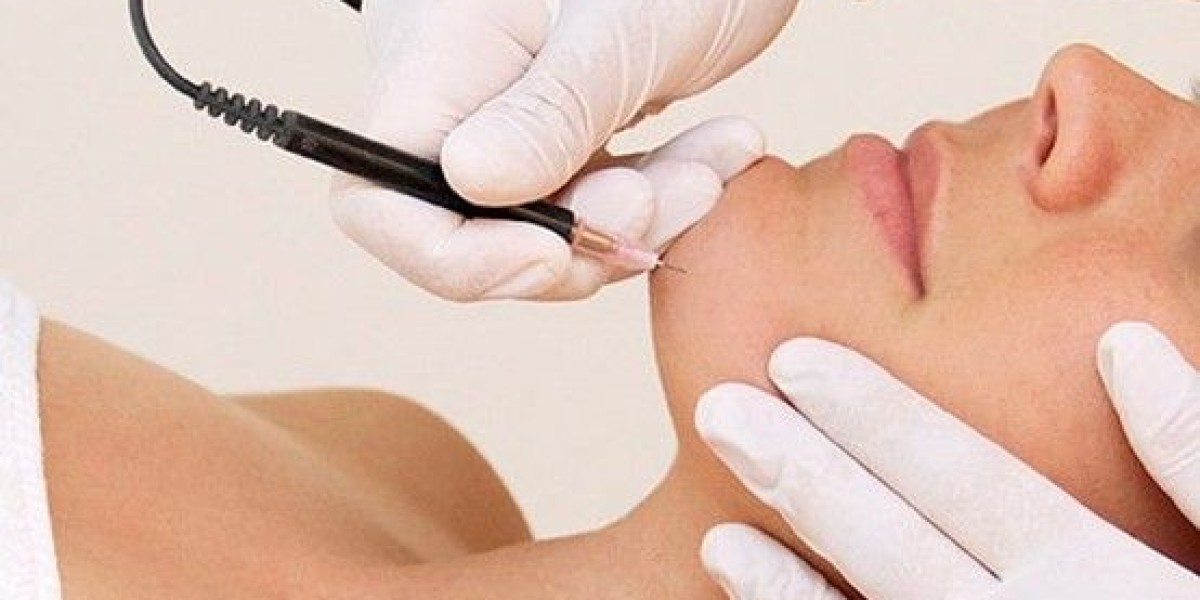 The Universal Solution: Is Electrolysis Hair Removal for All Skin Types?