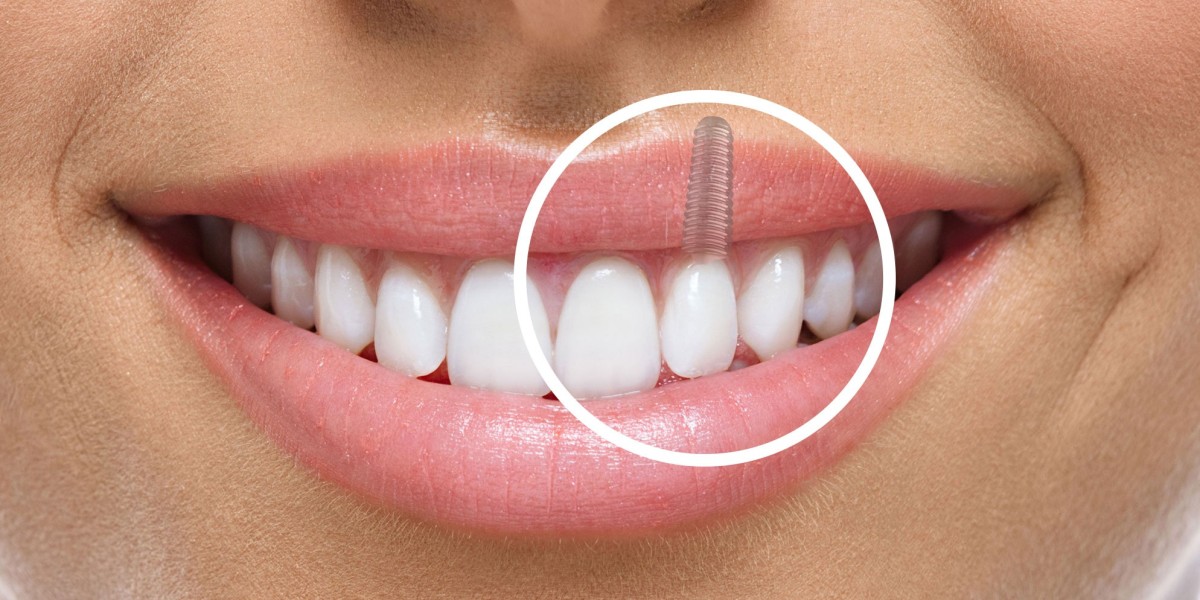 Say It with a Smile Rebuilt by Dental Implants Dubai