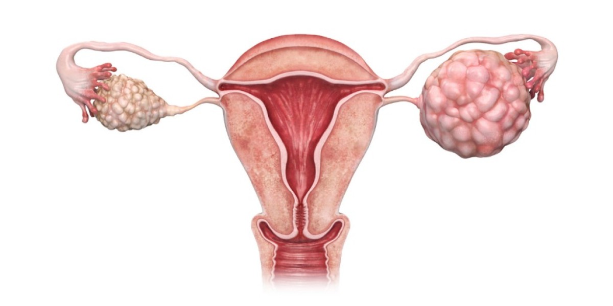 PCOS Treatment Market Report – Global Trends & Future Outlook