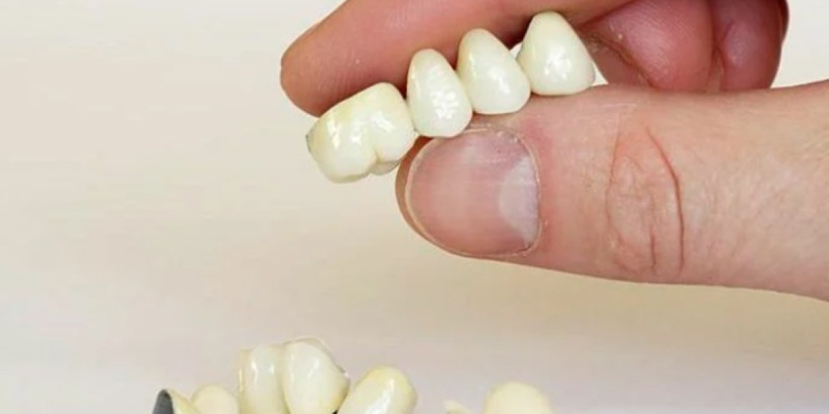 Có nên lựa chọn bọc răng sứ Titan không?