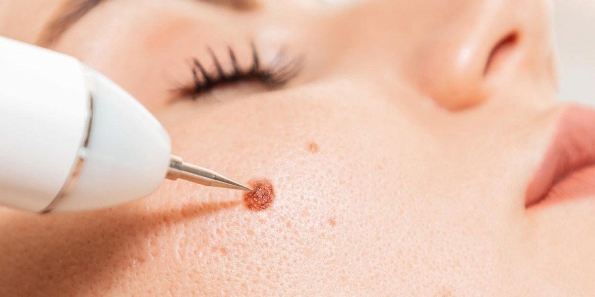 New Year, New Skin: Wart Removal Plans in Islamabad