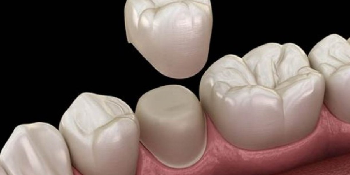 Bọc răng sứ giá bao nhiêu? Địa chỉ nào giá tốt nhất?