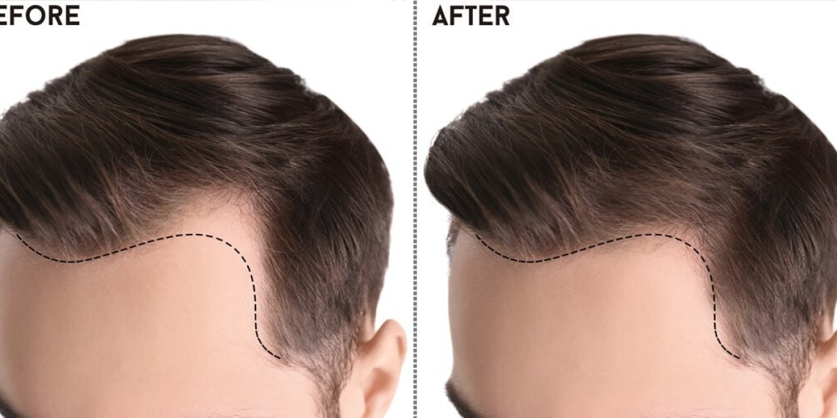 Rediscovering Confidence: A Comprehensive Guide to Hair Transplants in Islamabad