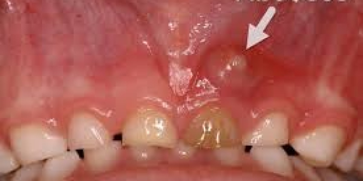 Aspadol for Dental Abscess: A Strong Option for Severe Tooth Pain