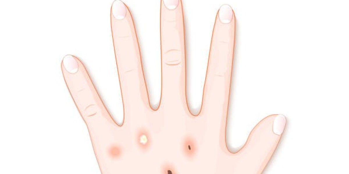 Actinic Keratosis Treatment Market Size Share Driven by Topical Therapy Demand