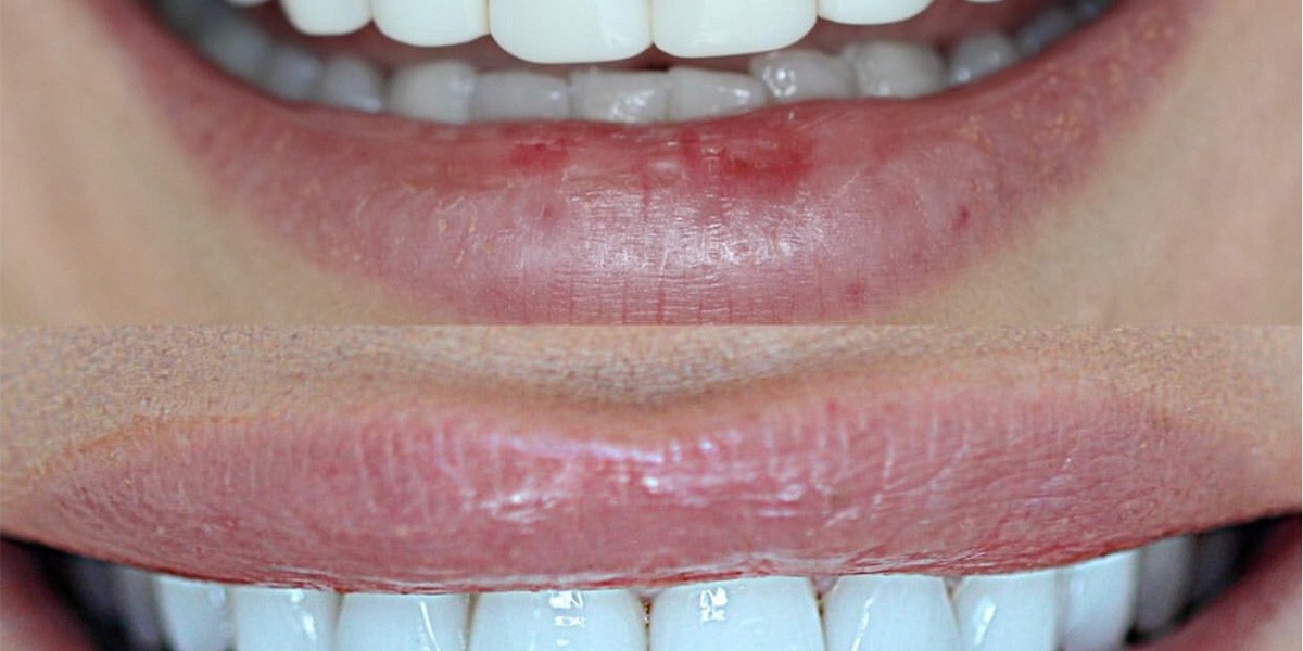 Does Teeth Whitening Cost More with Sensitive Teeth