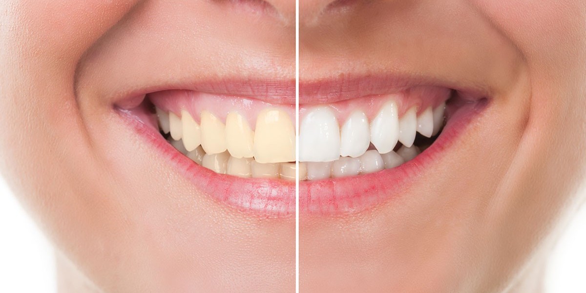 What Makes Laser Teeth Whitening Cost More Than Other Methods?