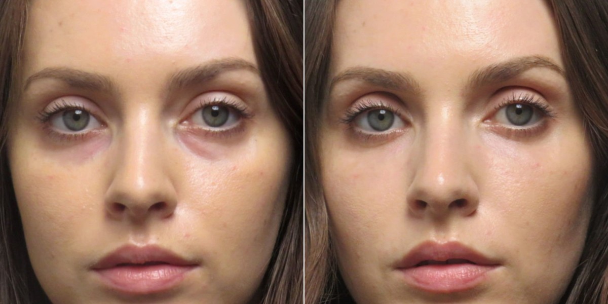 Where to Get Natural-Looking Under Eye Fillers in Islamabad
