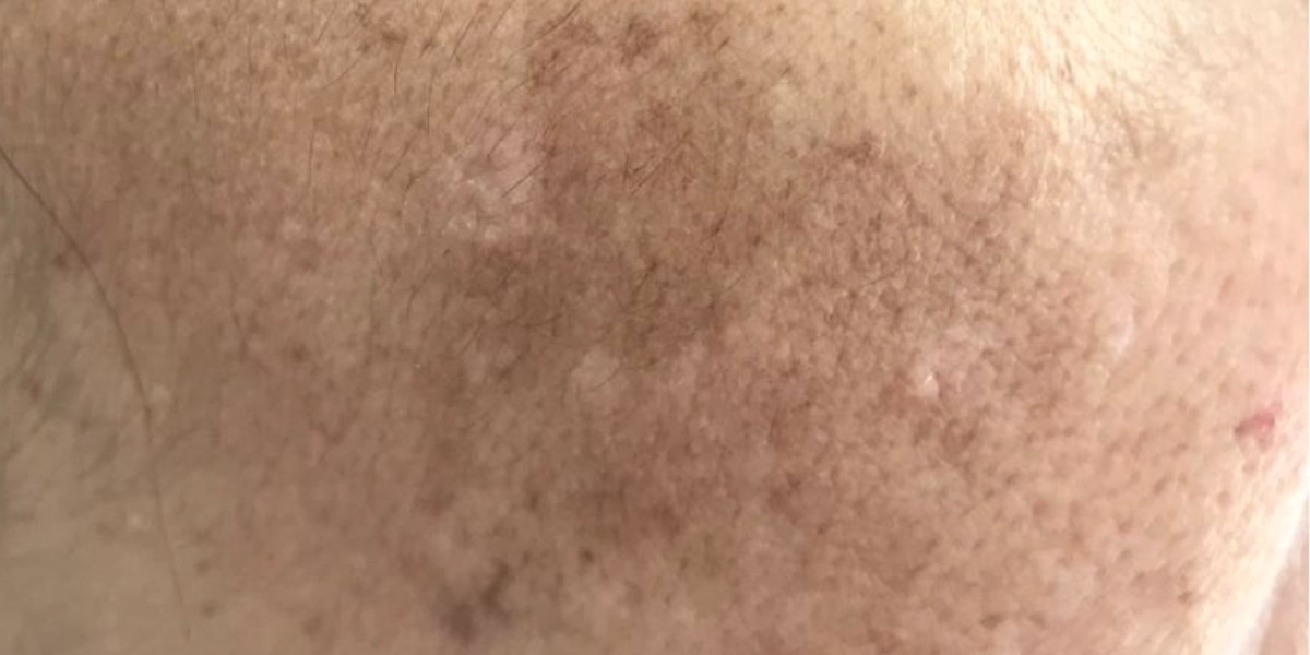 How Does Dermal Pigmentation Work on Skin?