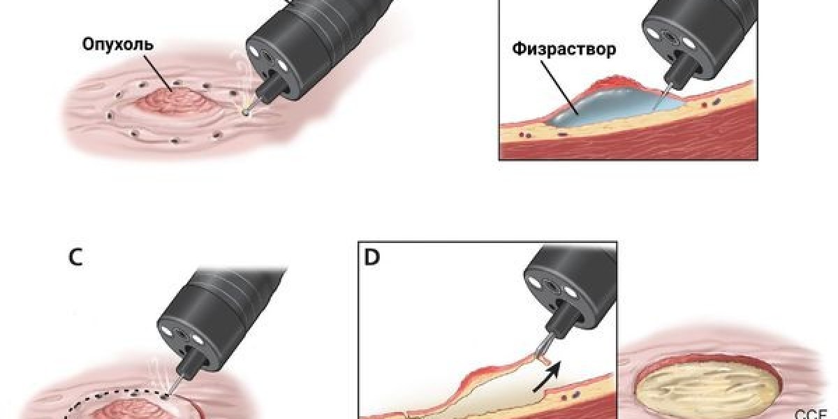 Endoscopic Submucosal Dissection Market Size, Share & Forecast 2022-2032