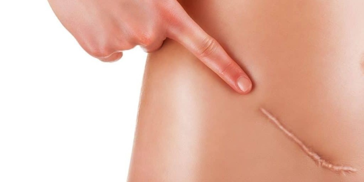 Aesthetic Goals vs. Budget: Balancing Laser Scar Removal Cost and Results