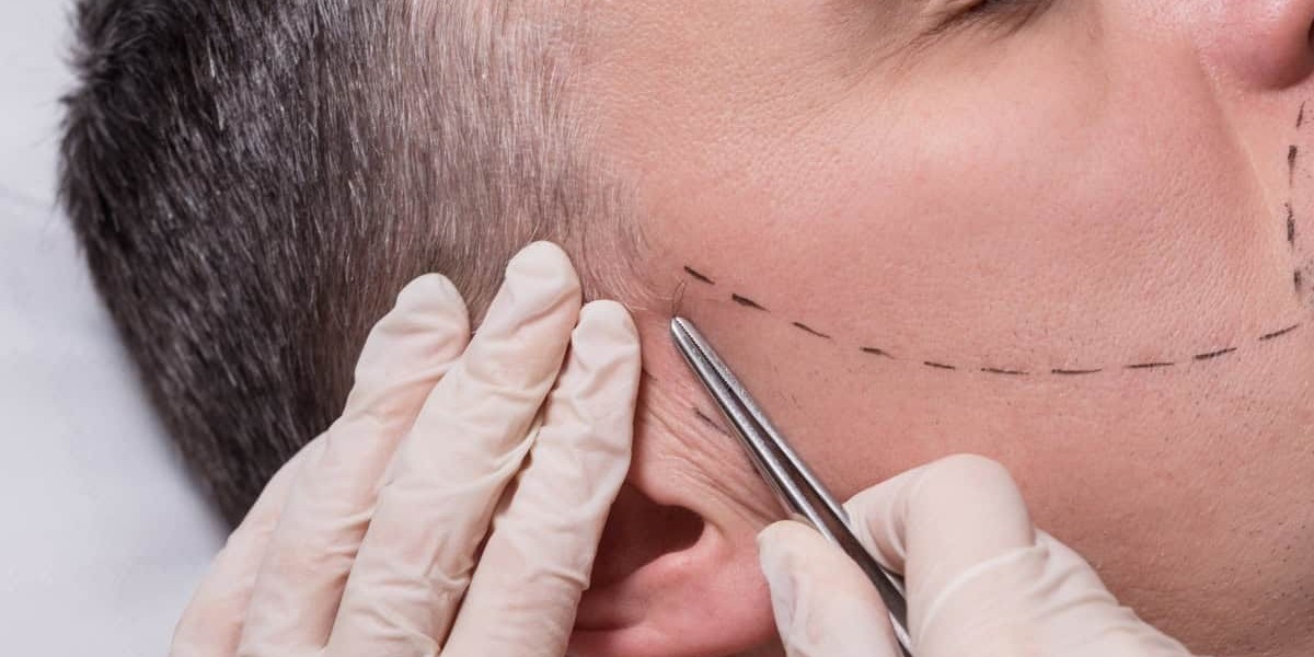 Can Beard Hair Transplant Help a Thin Beard Grow?