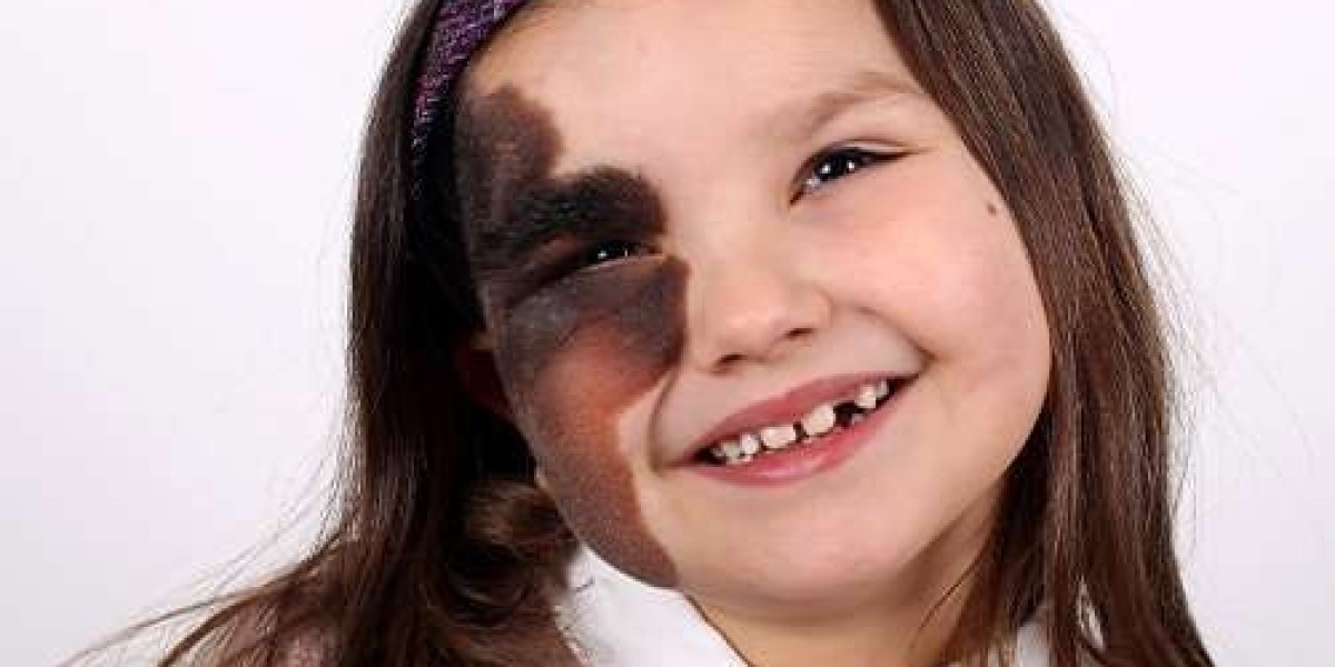 Birthmark Removal in Dubai Using Advanced Laser Techniques
