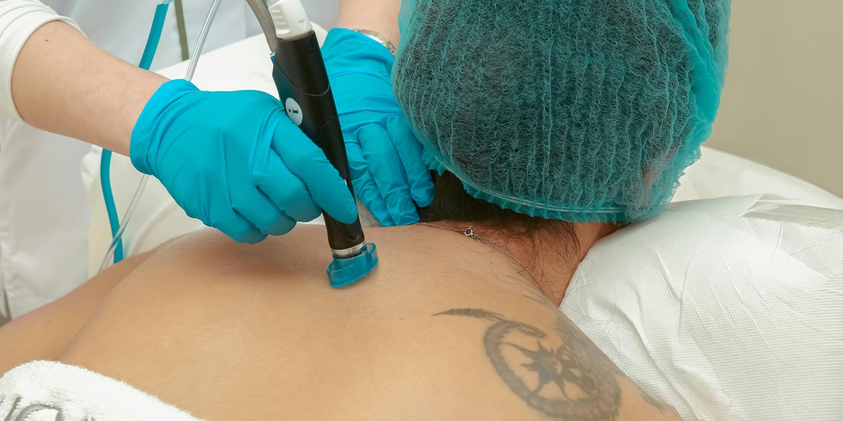 Tattoo Removal: Your Complete Guide to Safe, Effective Laser Removal