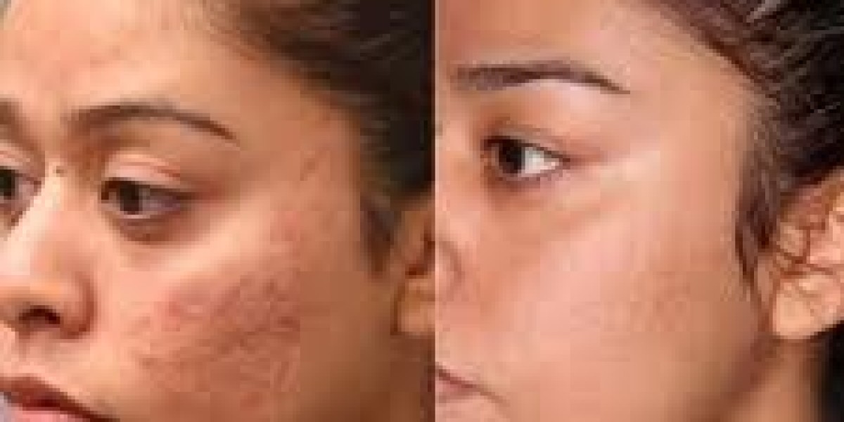 Acne Scars Treatment in Islamabad – Restore Your Confidence