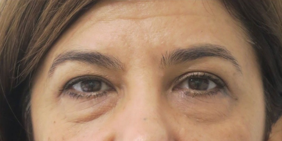 Rinoplastia en Madrid: Diferencias entre Técnica Abierta y Cerrada