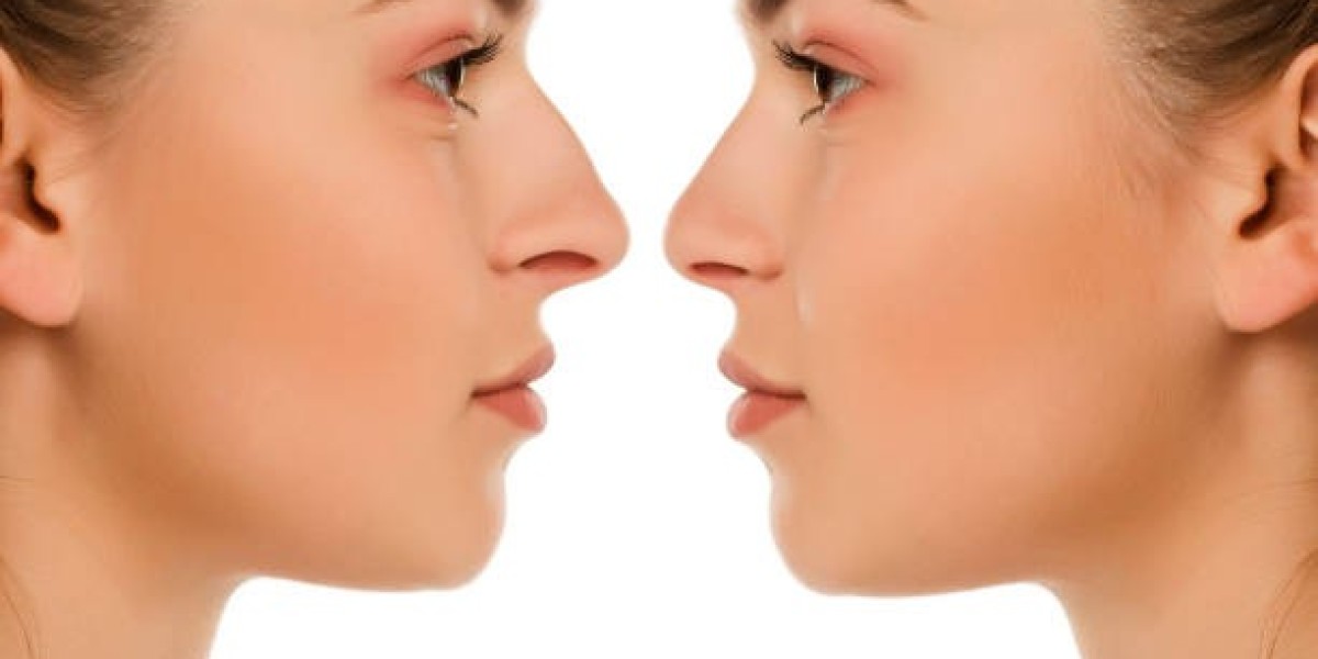Tips for Maintaining Results After Rhinoplasty Procedure