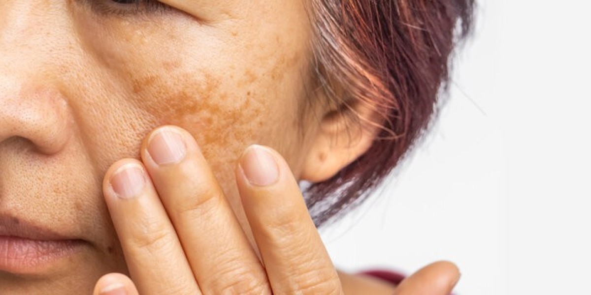 Anti-Pigmentation Laser Treatment in Islamabad: Effective Solutions
