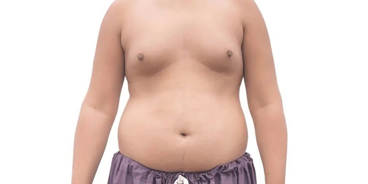 How Do I Know If I Have Gynecomastia?