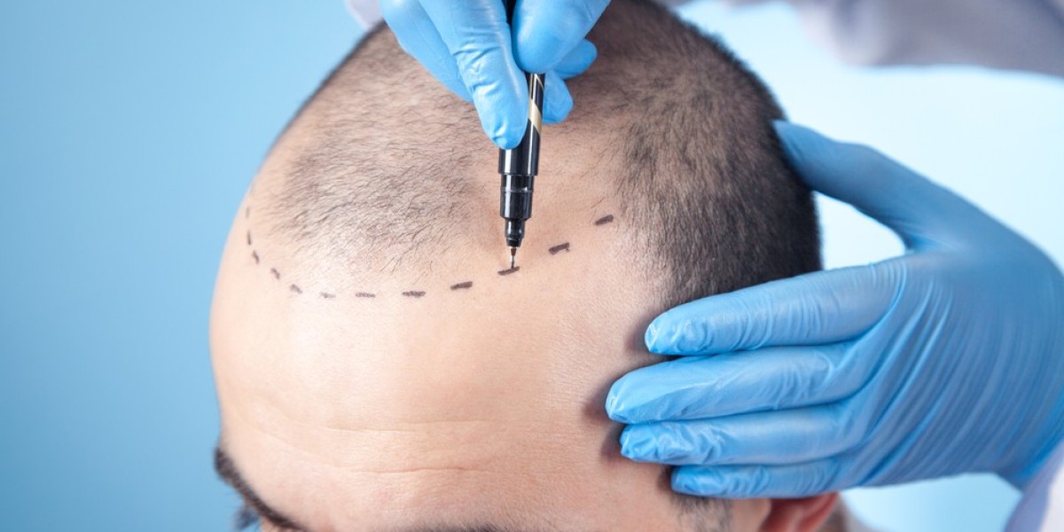 How Is FUT Hair Transplant Different From FUE?