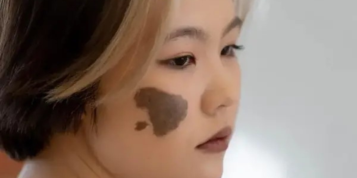 Can Birthmark Removal Treatment Be Done on the Face?