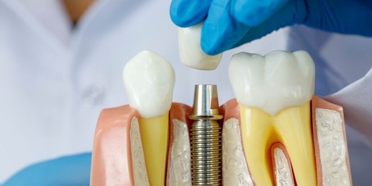 Smile Fully and Freely with Dental Implants Dubai Now
