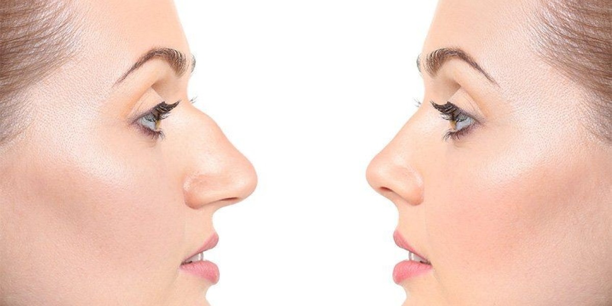 تجميل الأنف وتأثيره على الثقة بالنفس