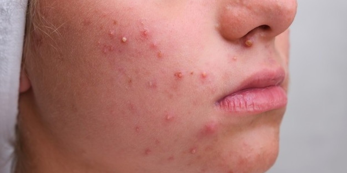 What Pimples Treatment Is Safe For Sensitive Skin?