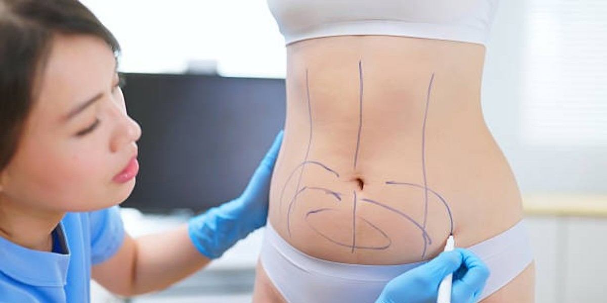 Lipo Abdominoplasty Recovery Timeline: A Complete Overview