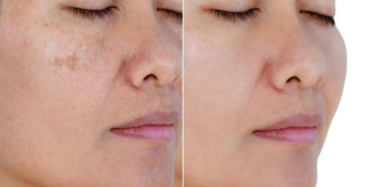 brighter and healthier skin with advanced treatments in Islamabad