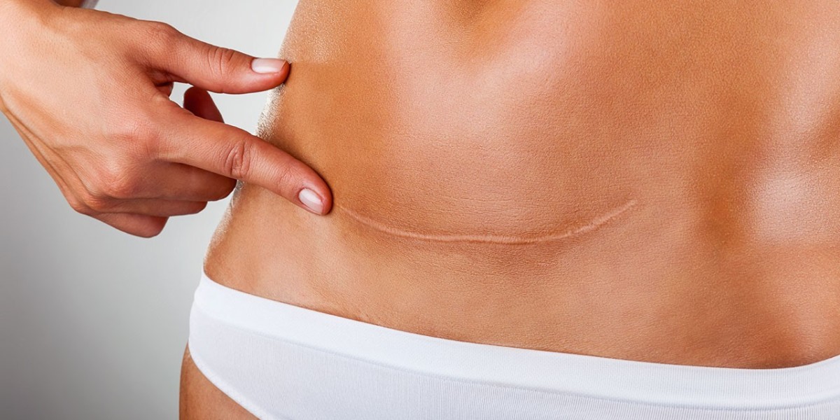 Surgical Scar Revision: Expert Techniques for Scar Healing