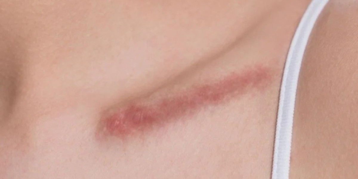 Does Laser Scar Removal Require Multiple Sessions?