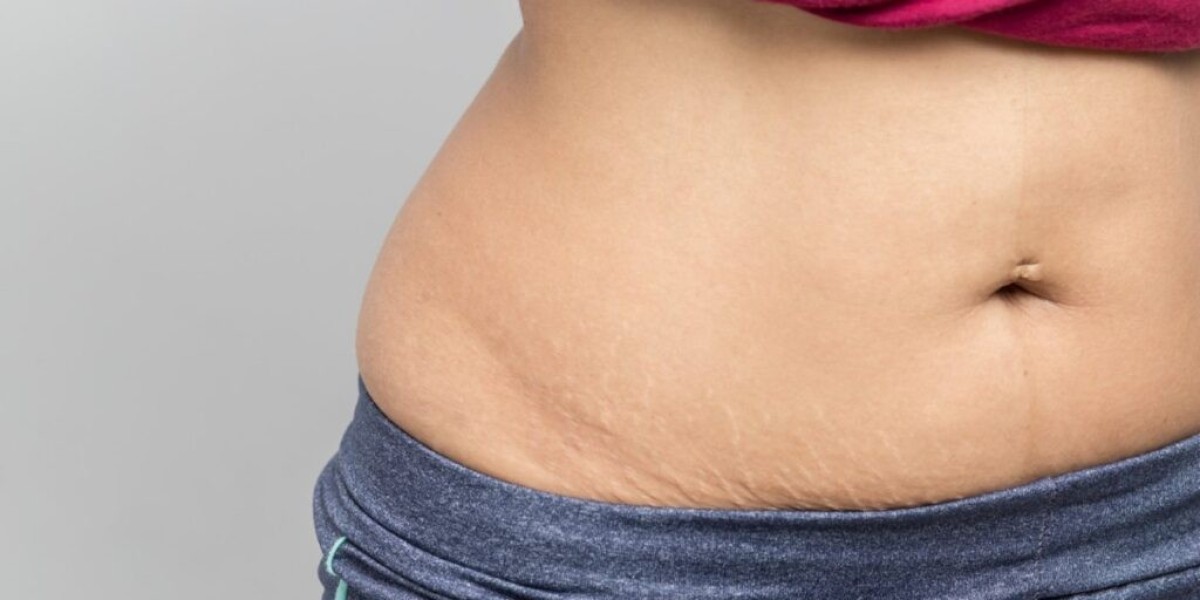 Is tummy tuck worth it for mothers after childbirth?