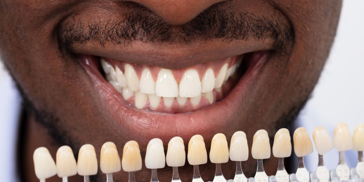 How Much Prep Do Teeth Need for Dental Veneers?