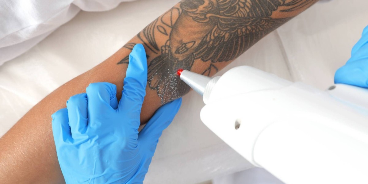 Reveal Clean Skin Fast with Laser Tattoo Removal Boost