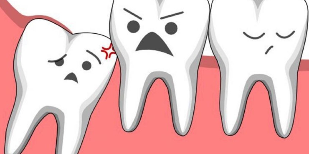 Nhổ răng khôn hàm trên có nguy hiểm không? Giải đáp chi tiết từ bác sĩ