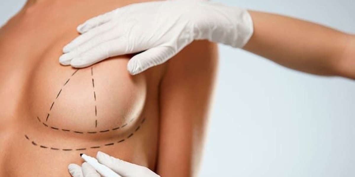 Life After Breast Reduction: Riyadh Success Stories