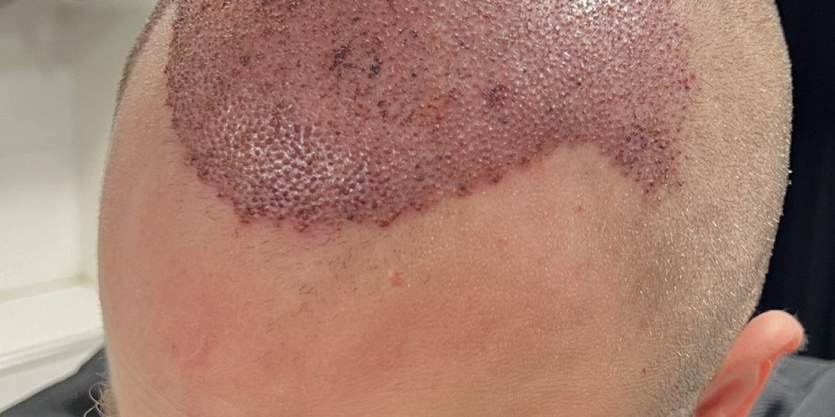 Is Hair Transplant Safe for All Skin Types?