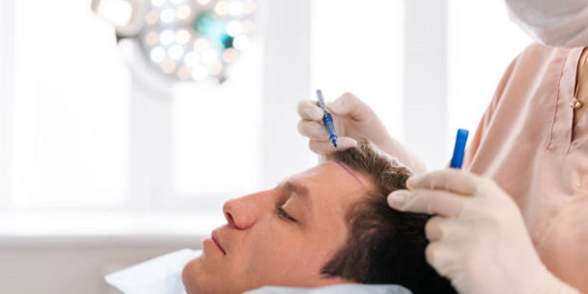 خطوات زراعة الشعر في الرياض بالتفصيل