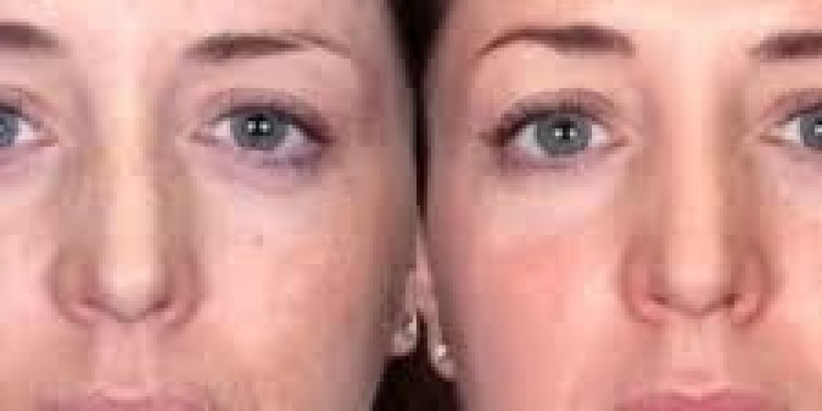 Melasma Treatment in Islamabad: A Complete Guide